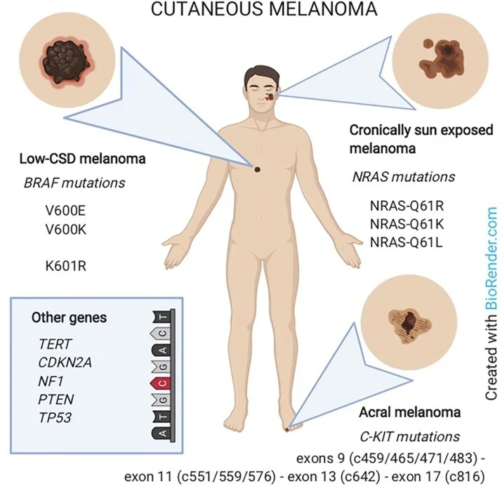 Illustration of cutaneous melanoma subtypes and mutations